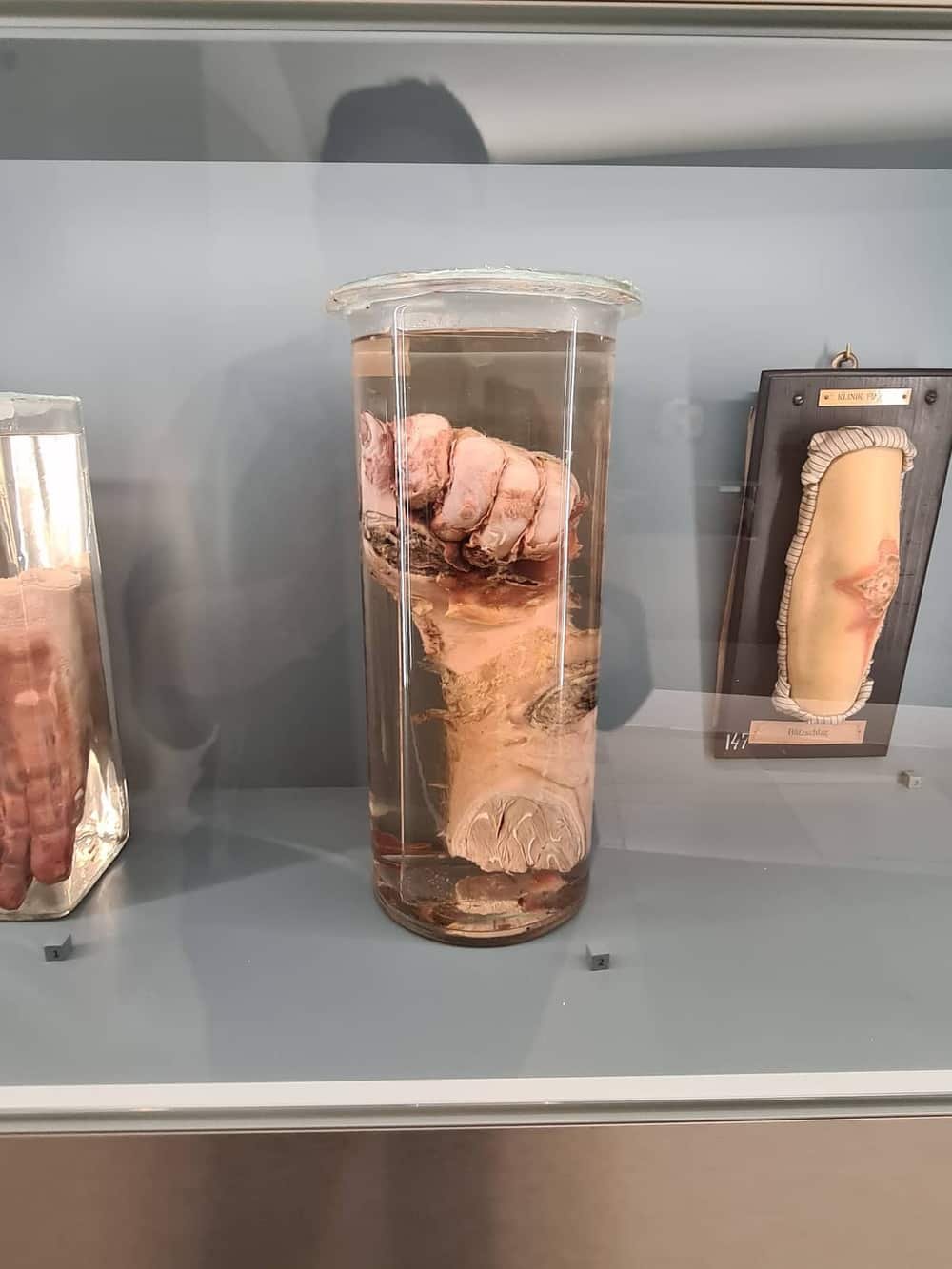 Pathological-anatomical collection in the Narrenturm — 2